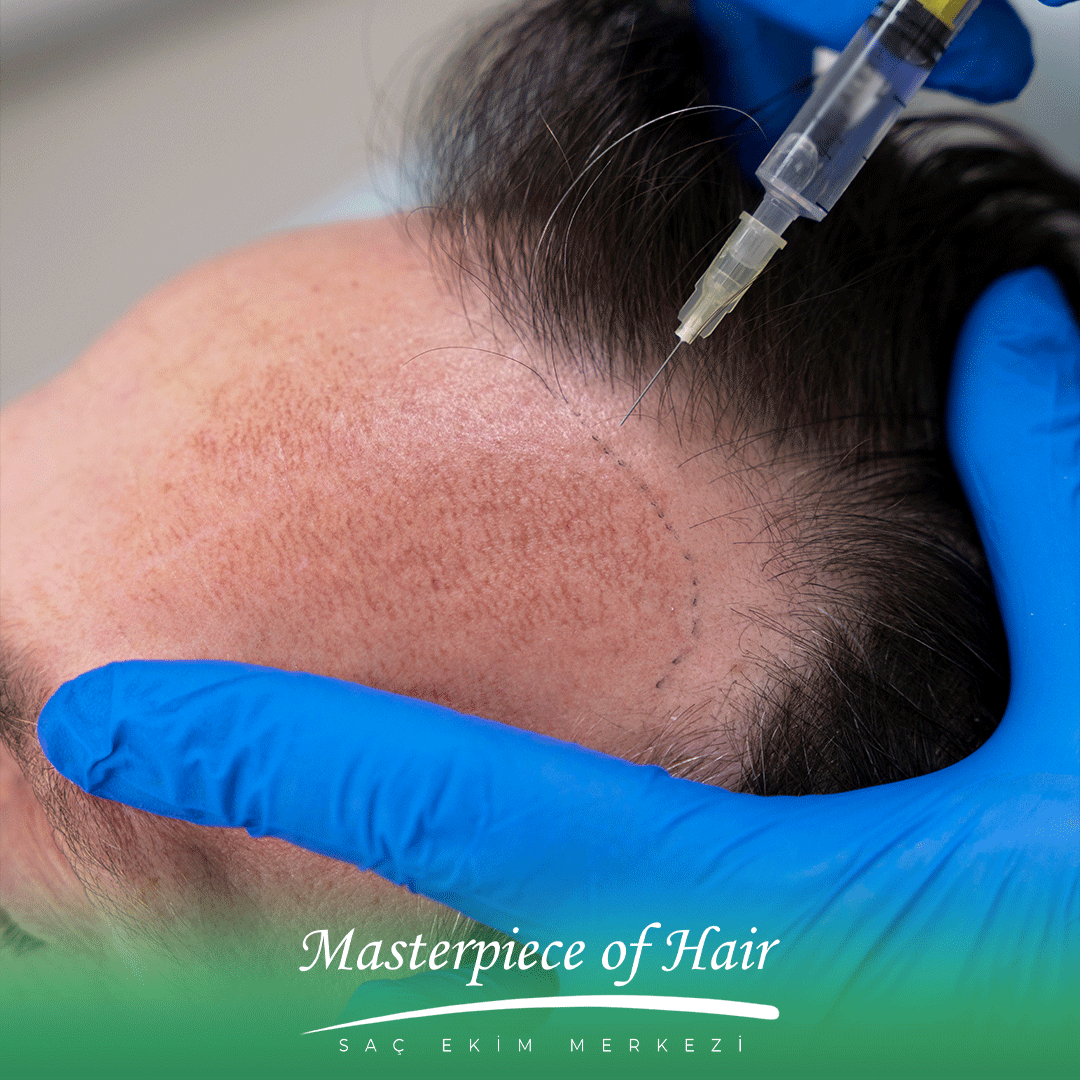 saç-dökülme-tedavileri-3