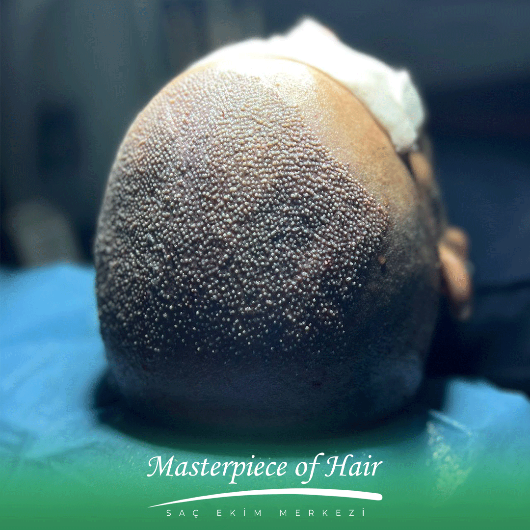 saç-ekimi-nasıl yapılır