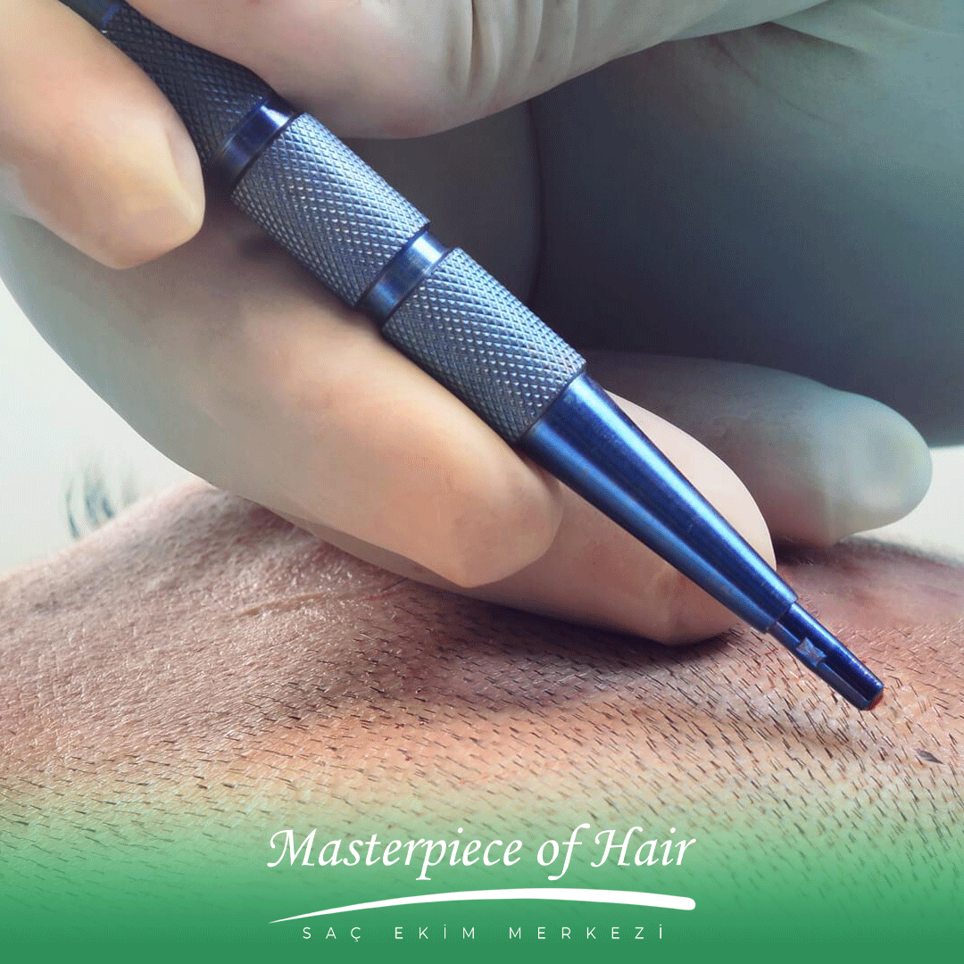 safir-fue-saç-ekimi